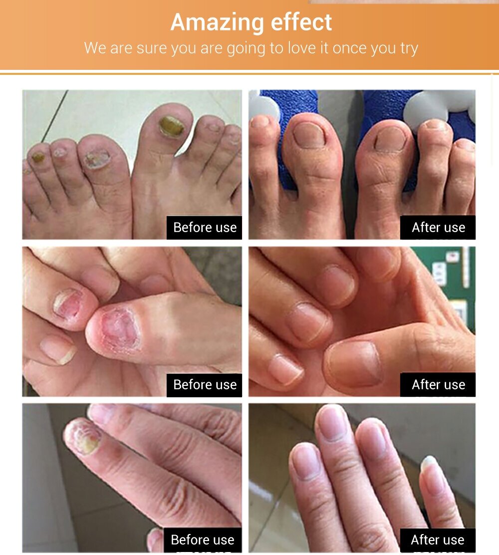 Средство от грибка ногтей на ногах LANBENA / Лечение, укрепление ногтей / Противогрибковое экстракт масло для ног, на ногти