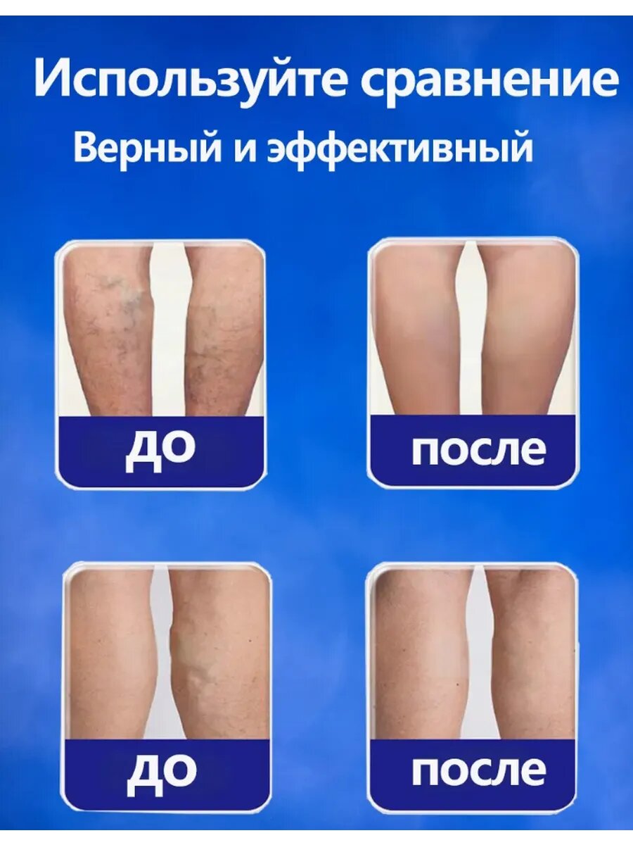 Пластырь от варикоза вен на ногах