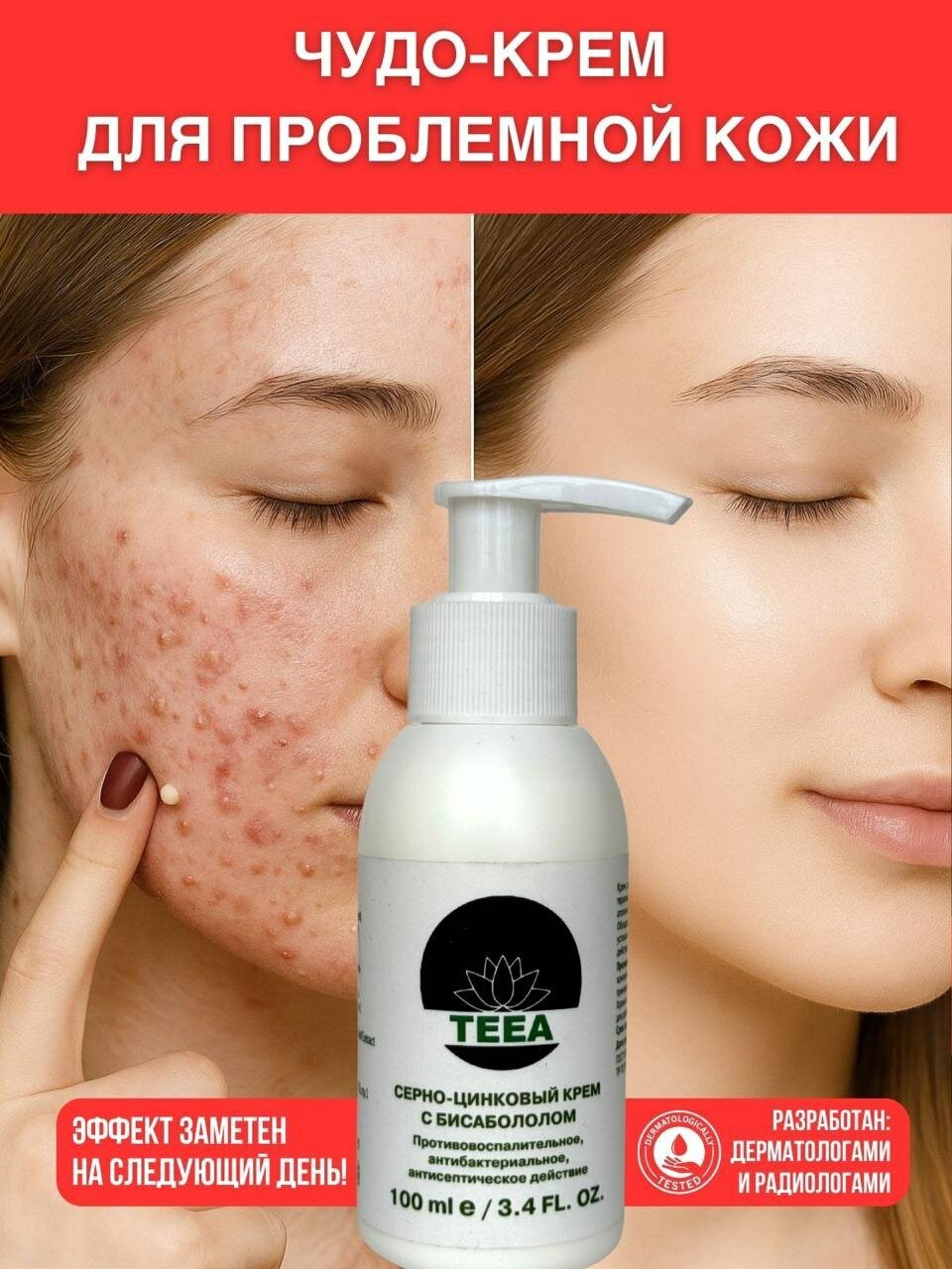 Крем от прыщей для лица Teea серно-цинковый с бисабололом 100 мл