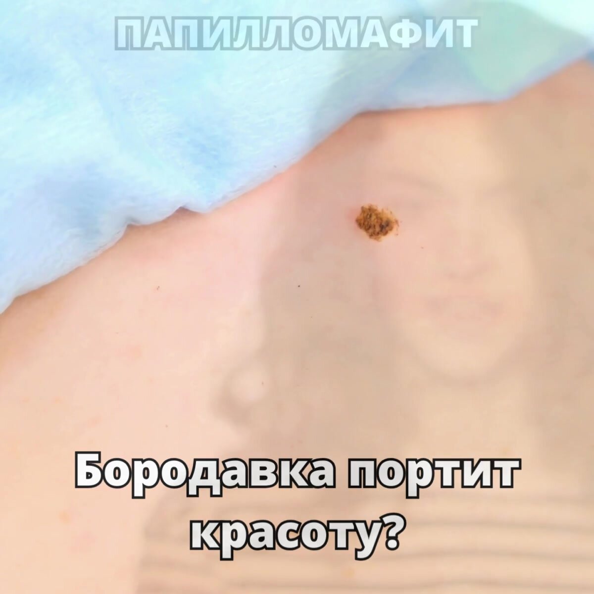 Крем-гель ПапилломаФит для удаления папиллом и бородавок с серебром и чистотелом, 1 шт. — фото 1