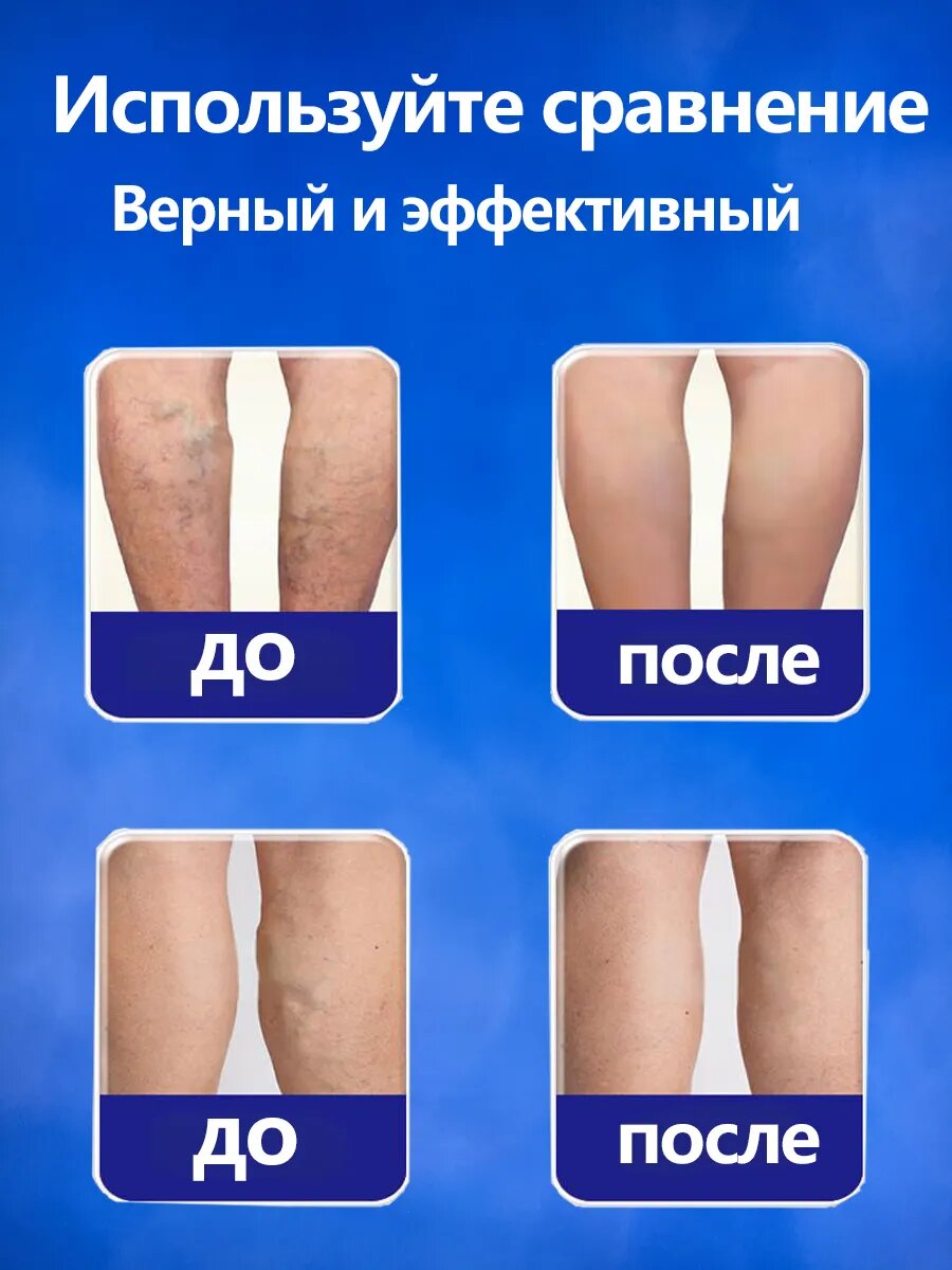 Картинки Пластыри от варикозного расширения вен