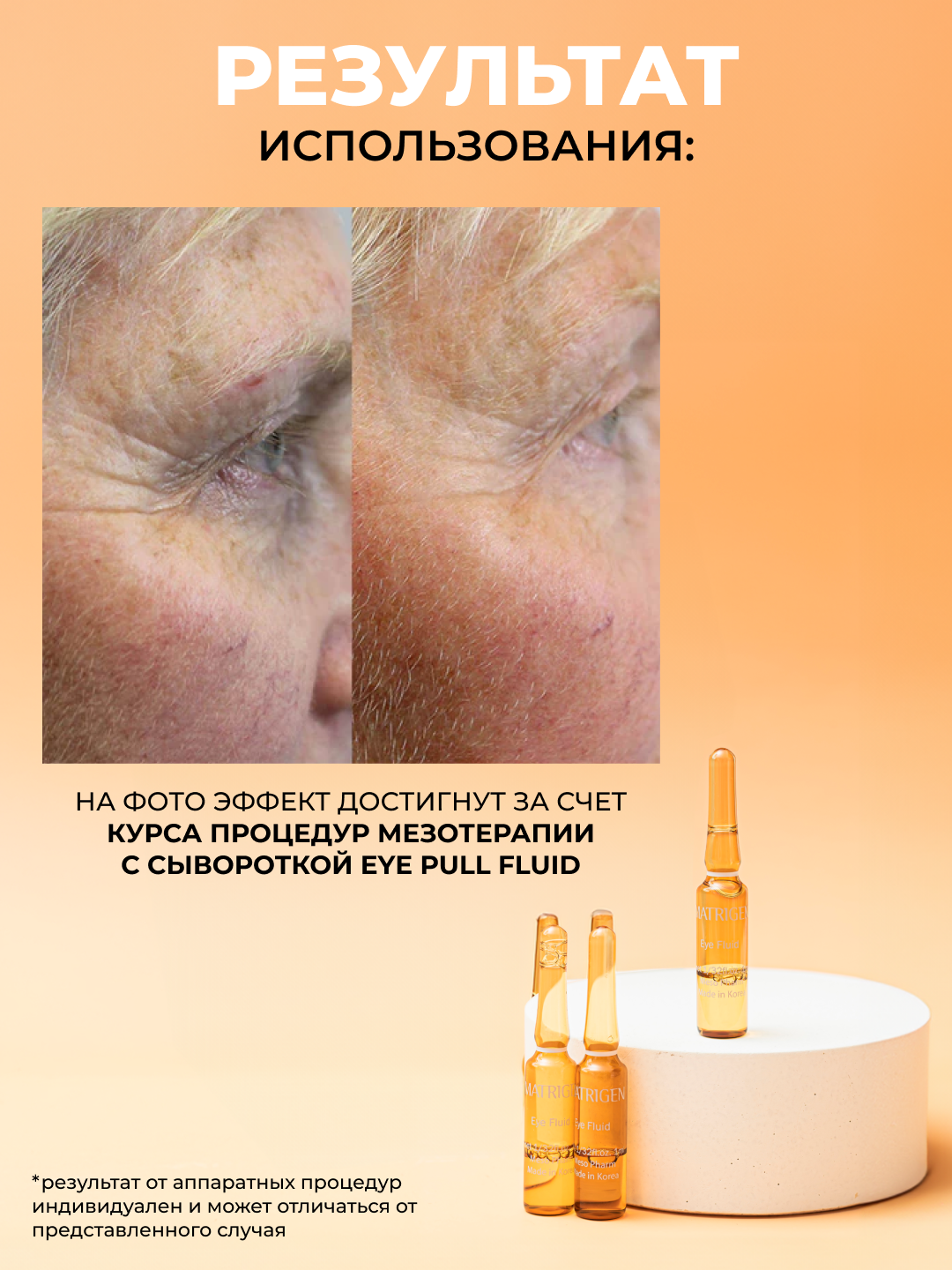 Matrigen Eye Pull Fluid Ампульная сыворотка - флюид для мезотерапии кожи вокруг глаз руками аппаратом, 20 шт х 1 мл — фото 1
