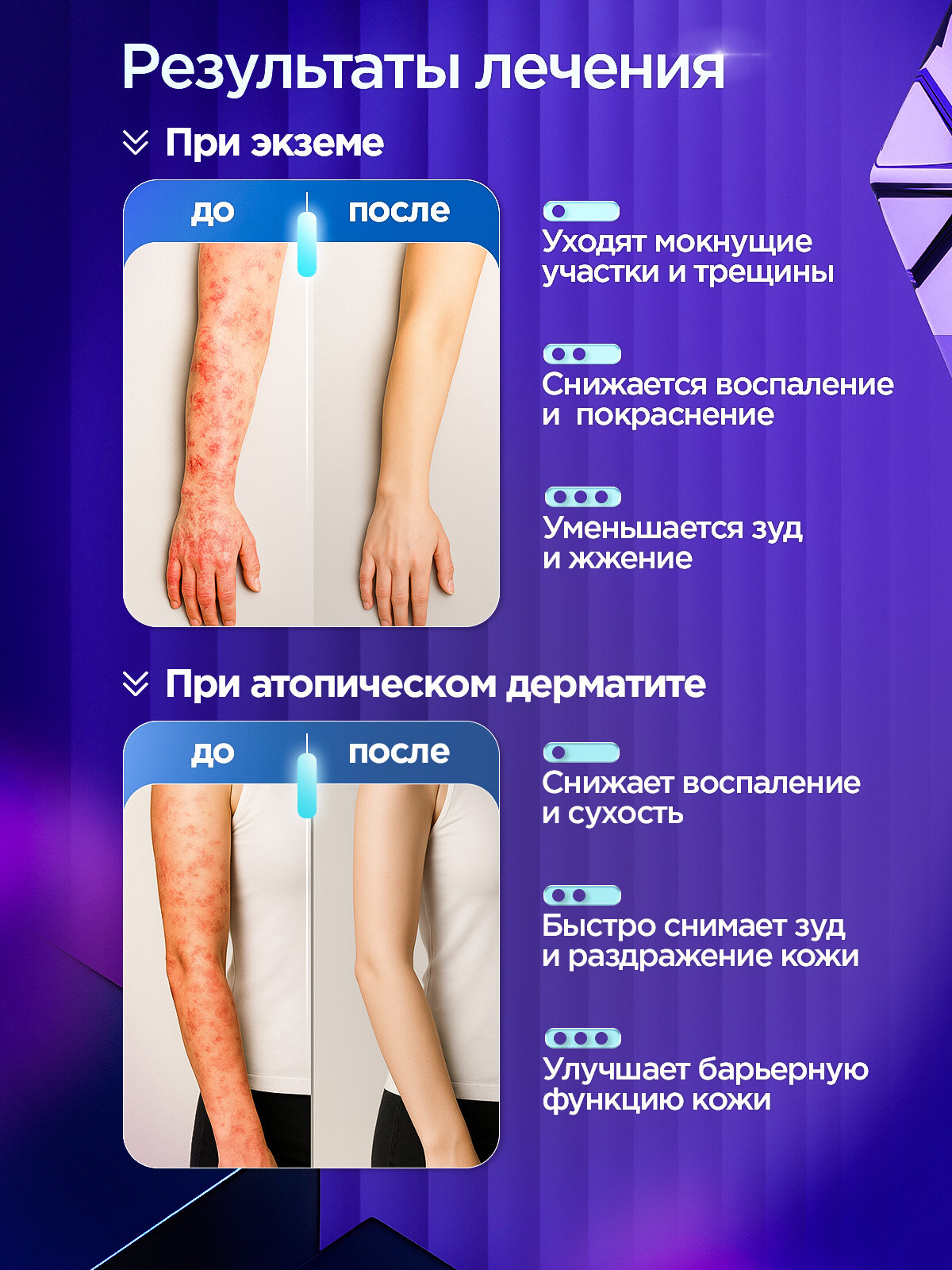 Облучатели Медицинские Облучатель ультрафиолетовый Ультрамиг-311Р (лампа Ultramig), лампа от псориаза, витилиго, экземы