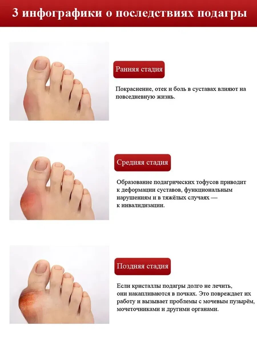 Картинки Мазь от подагры на ногах китай