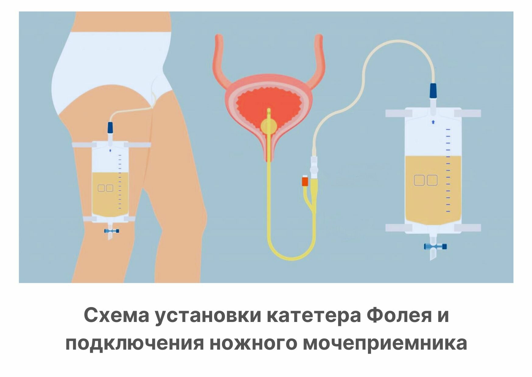 Катетер Урологический Катетер Фолея двухканальный CH/FR20, латекс покрытый силиконом, 40 см, баллон 30 мл
