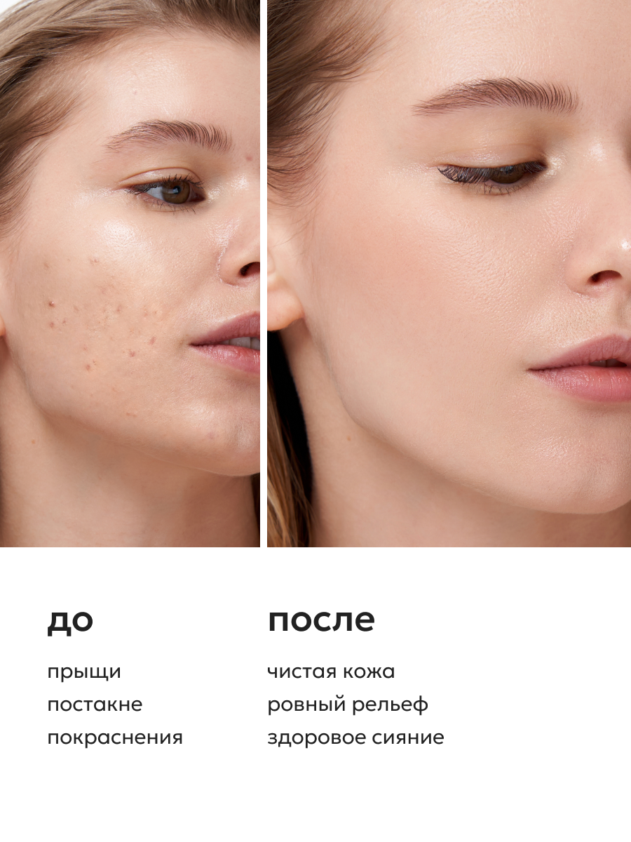 Лосьоны Для Лица Likato Professional/ Лосьон-спрей от прыщей для лица и тела, 200 мл