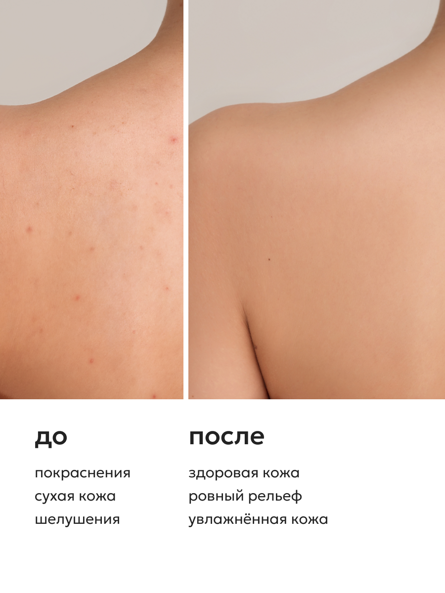 Молочко-флюид для тела уход за проблемной кожей ACNE CONTROL, 250 мл — фото 1