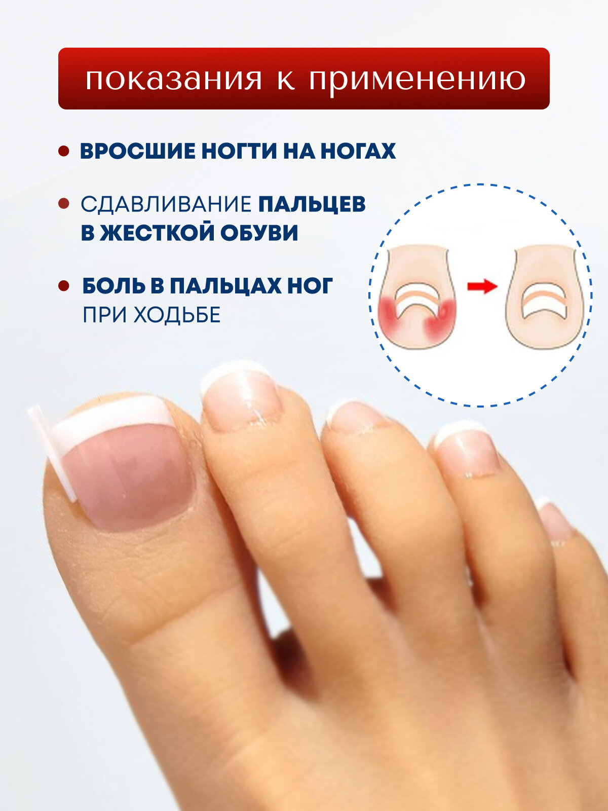 Вставка MyBalance, для педикюра, от вросших ногтей, 10 штук, бесцветный — фото 1