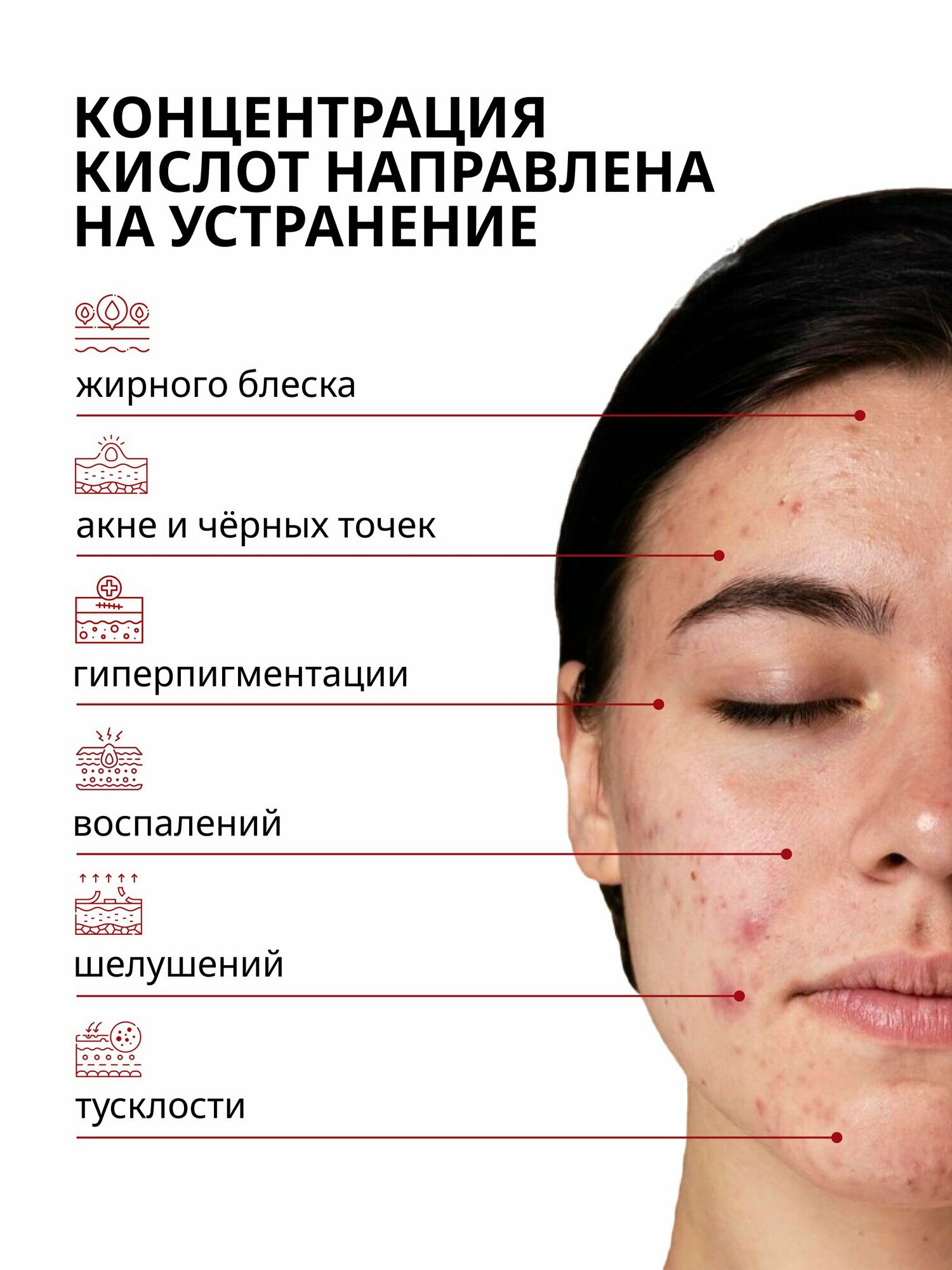 Изображение Кровавый кислотный пилинг для лица от прыщей и акне AHA BHA, Алтея 30 мл