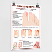 Медицинский плакат "Онихокриптоз, Вросший ноготь" / А-2 (42x60 см.)