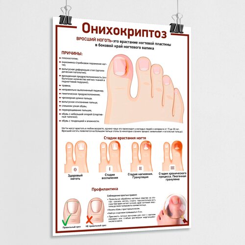 Медицинский плакат "Онихокриптоз, Вросший ноготь" / А-2 (42x60 см.)