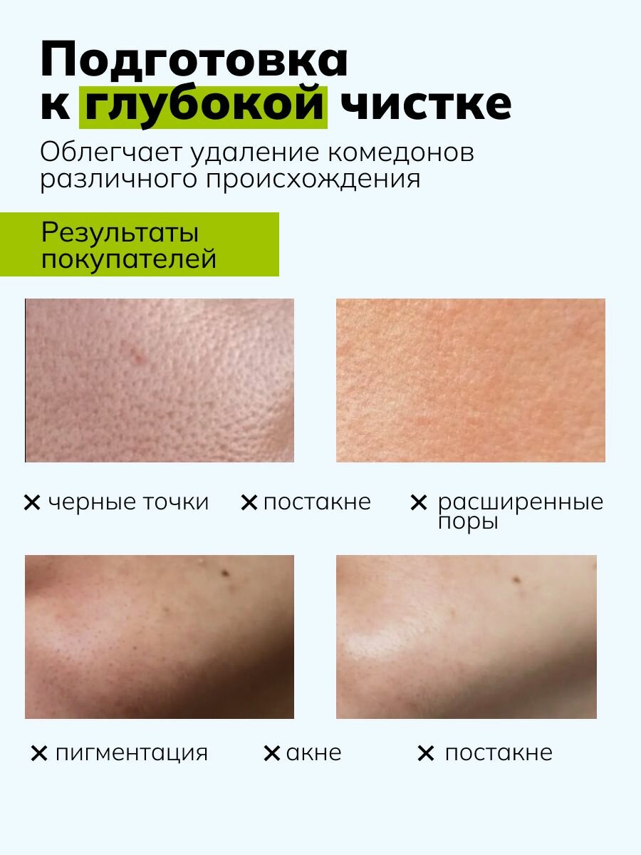Лосьоны Для Лица ART&FACT. / Лосьон для растворения закрытых комедонов с экстрактом ромашки 3% , 150 мл