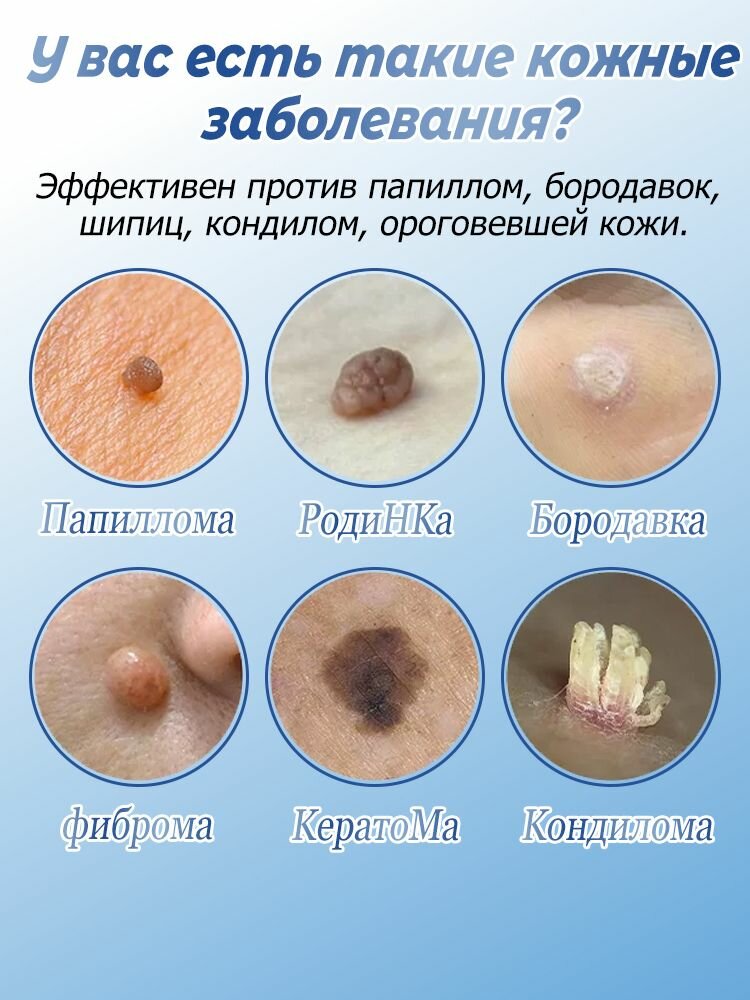 Картинки Средство от папиллом и бородавок, для удаления бородавок папиллом, сухих мозолей на ногах и теле, безболезненно 20 г