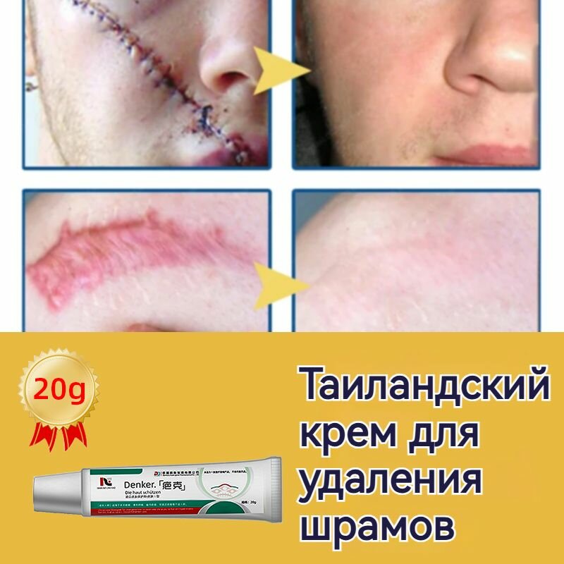 Немецкий Крем от шрамов и рубцов 20 г гель от прыщей на лице мазь против ожогов и пигментных пятен и теле средство от постакне