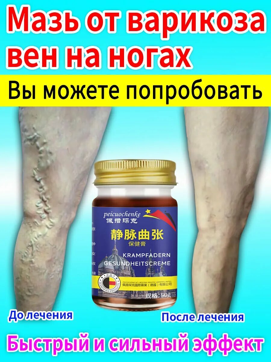 Избавляем от варикоза вен на ногах мазь