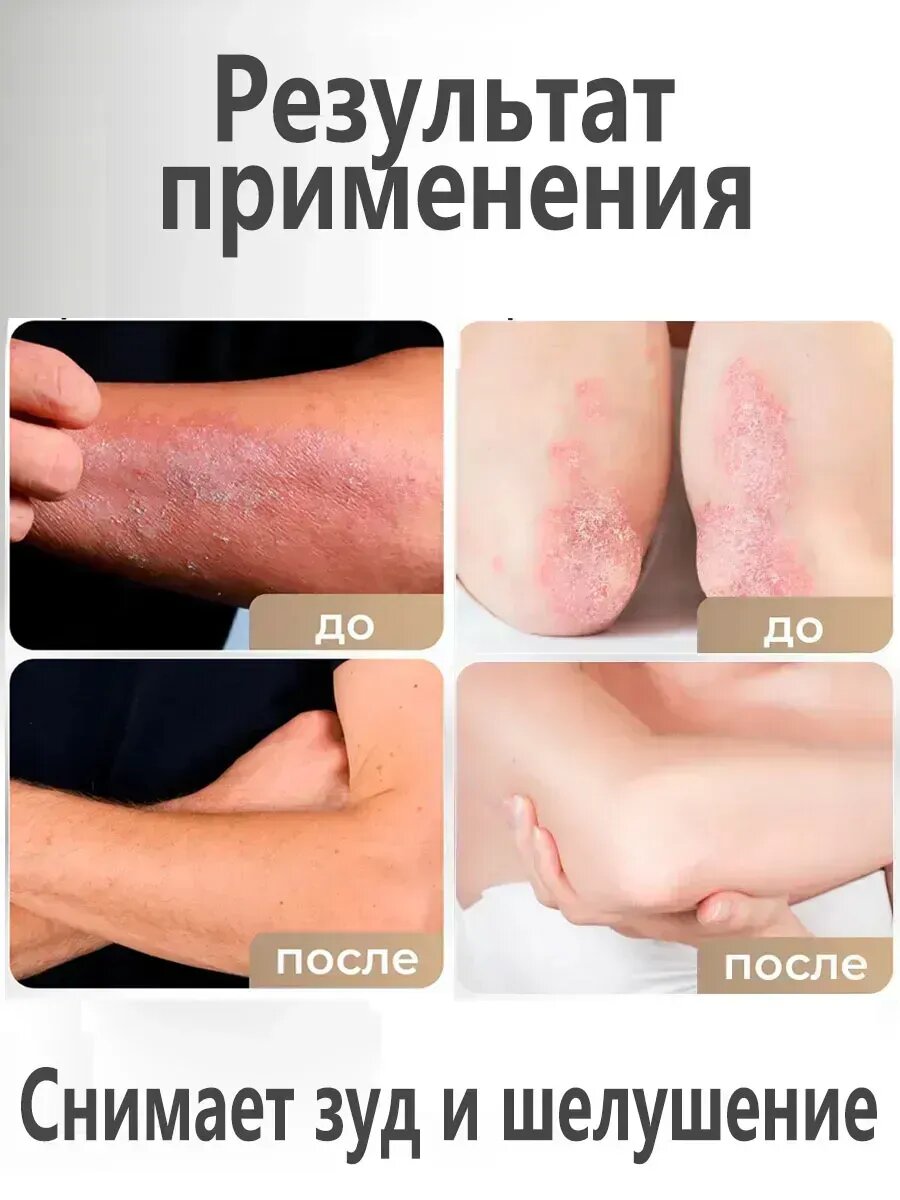 Крем от псориаза и дерматита