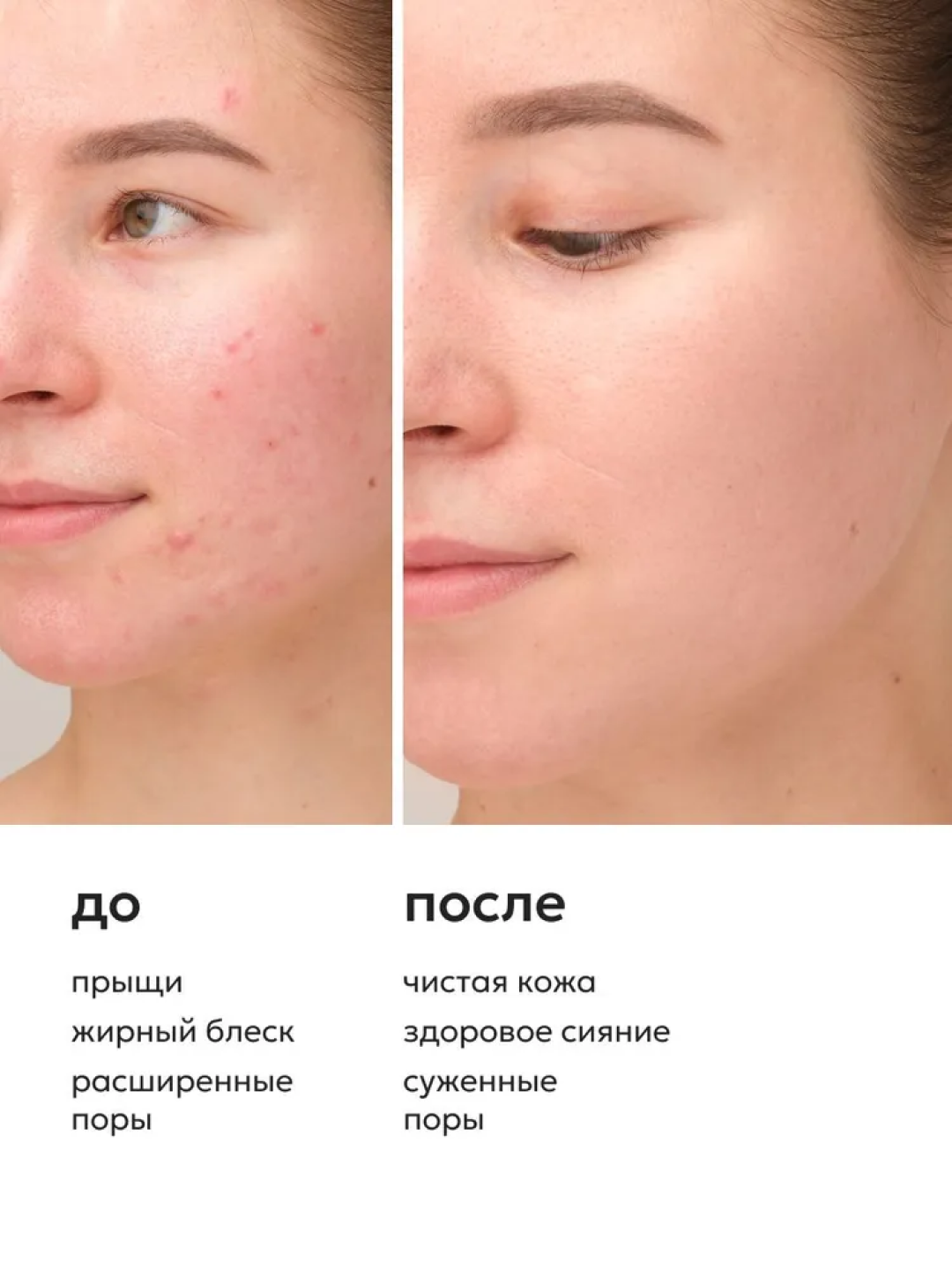 Сыворотка для кожи лица Likato akne killer против акне, прыщей и угрей, ниацинамид, 30 мл — фото 1