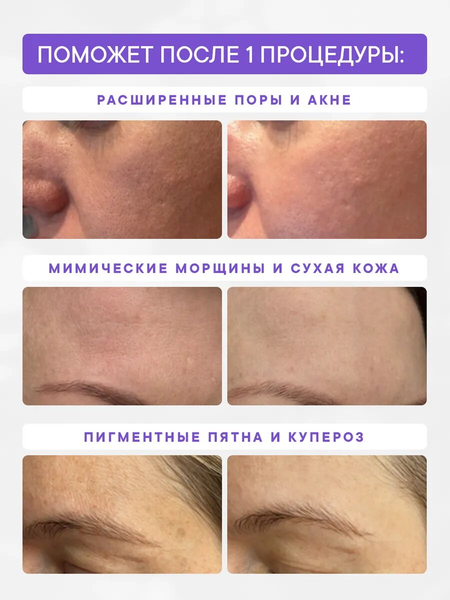 Аппарат карбокситерапия LED терапия с расходниками Asia Care — фото 1