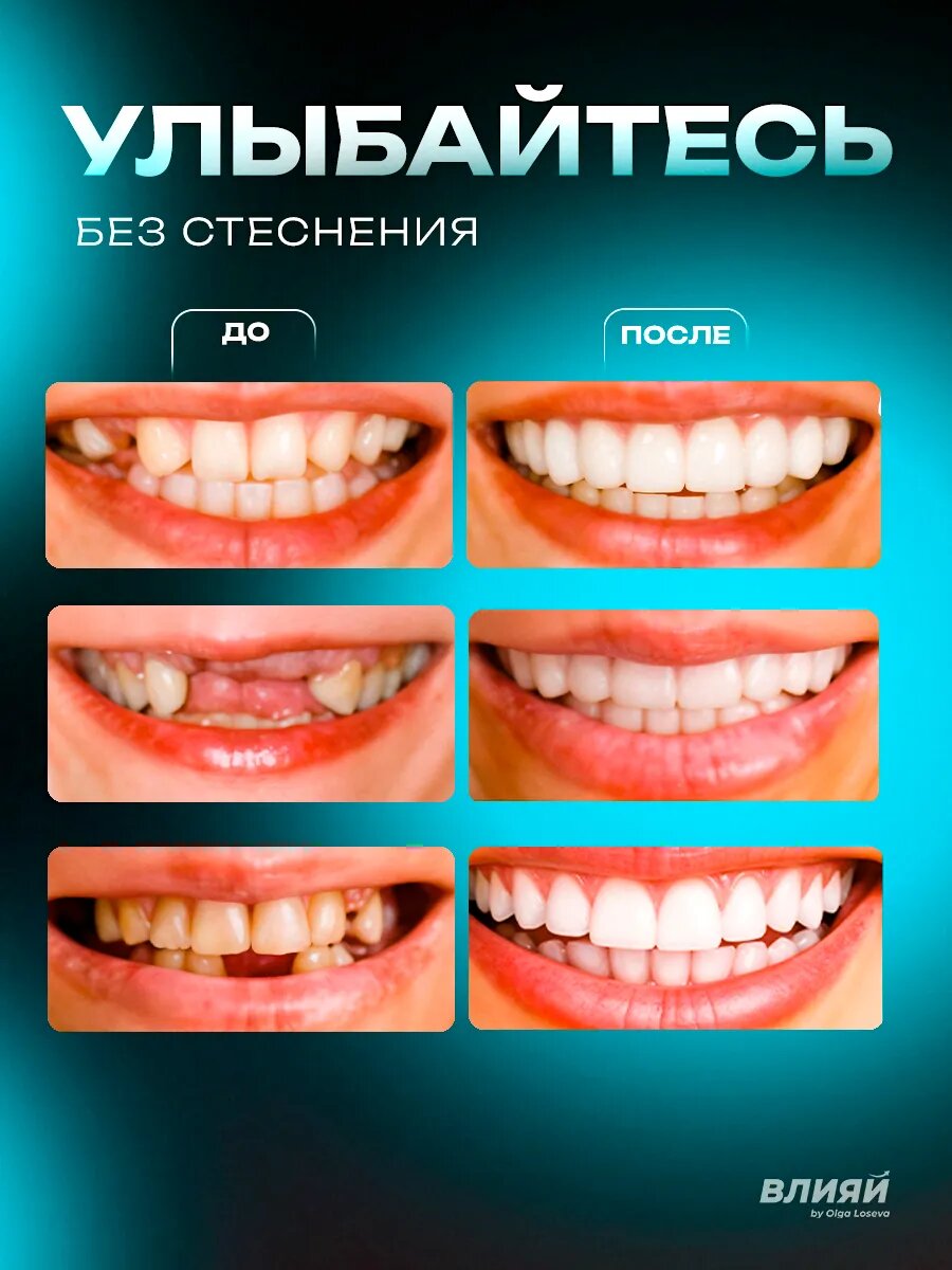 Виниры для зубов универсальные готовые зубные протезы — фото 1