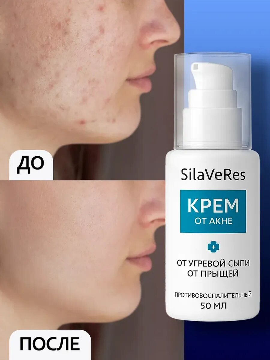 Крем при прыщах и акне, 50 мл — фото 1