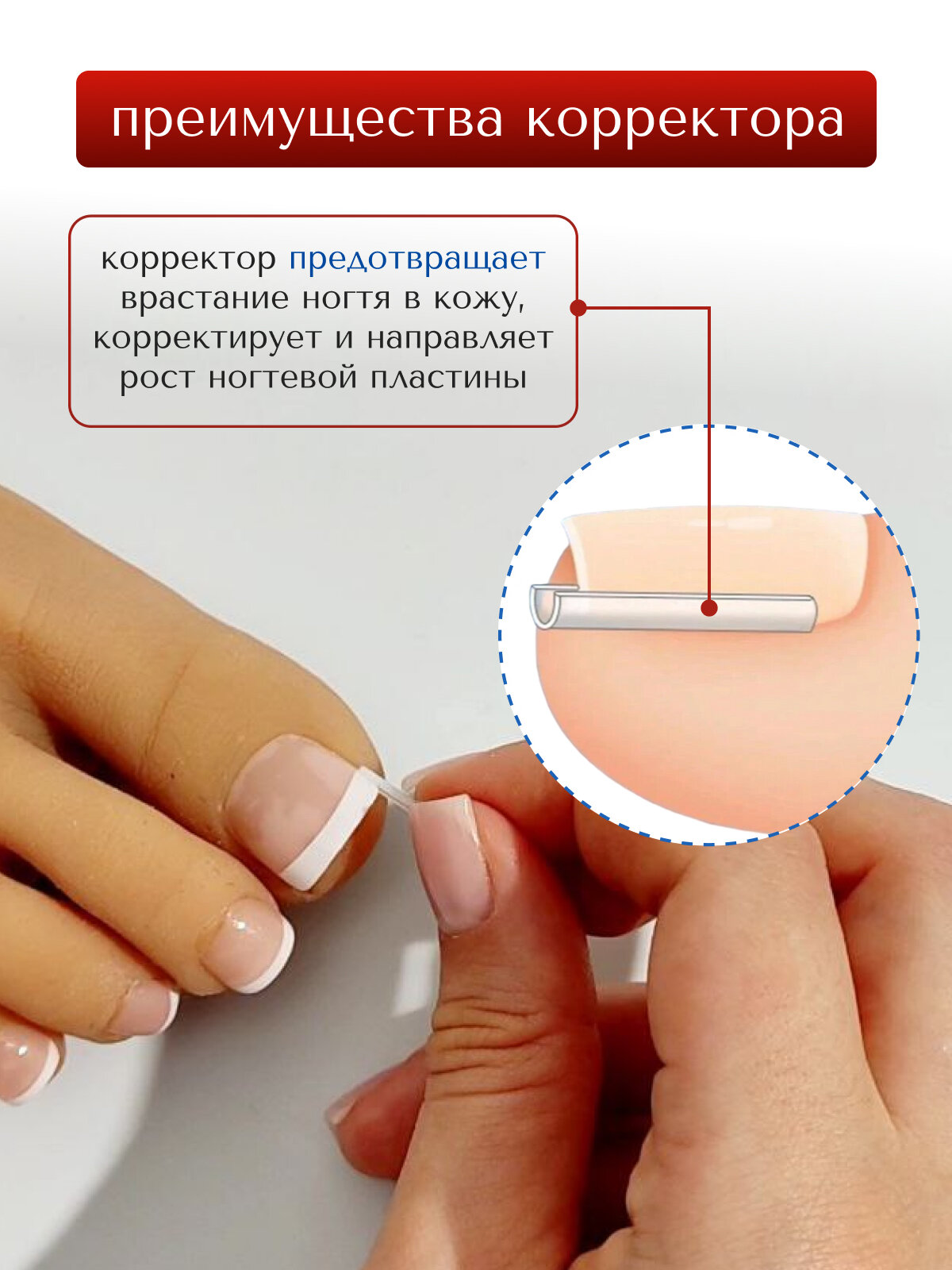 Вставка MyBalance, для педикюра, от вросших ногтей, 10 штук, бесцветный — фото 1