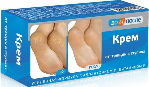 Крем для ног от трещин в ступнях До и после 150мл