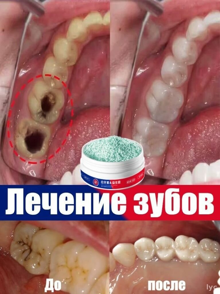 Эксклюзивный зубной порошок с пробиотиками и жемчужной эссенцией 50 г для отбеливания, укрепления десен и устранения неп