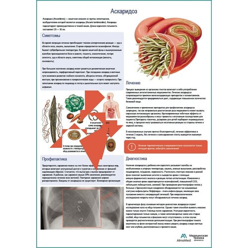 Аскаридоз медицинский плакат матовый холст от 200 г/кв.м, размер A1+