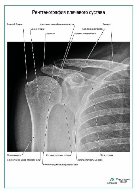 Рентгенография плечевого сустава плакат глянцевая фотобумага от 200 г/кв. м, размер A1+