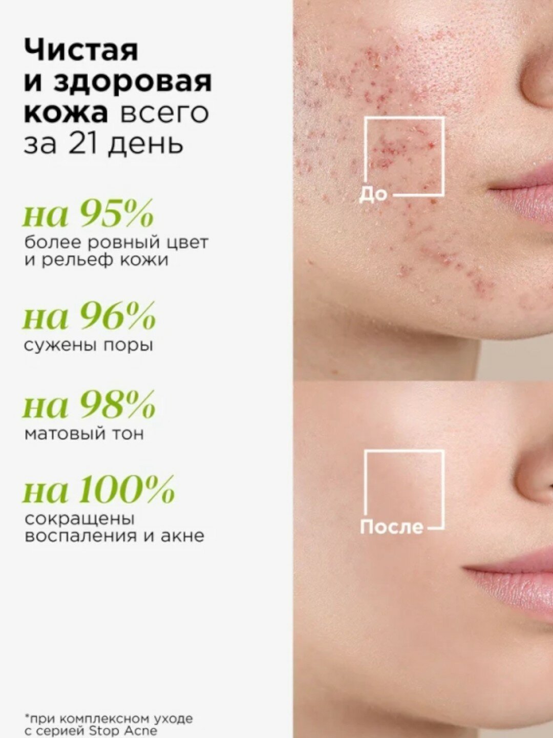 Тоник с кислотами для проблемной кожи Mixit Stop Acne face tonic 150мл
