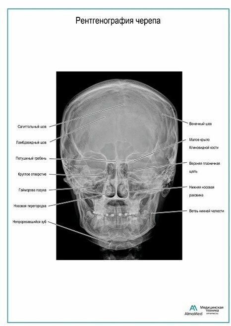 Рентгенография черепа, плакат, матовый холст от 200 г/кв. м, размер A1+