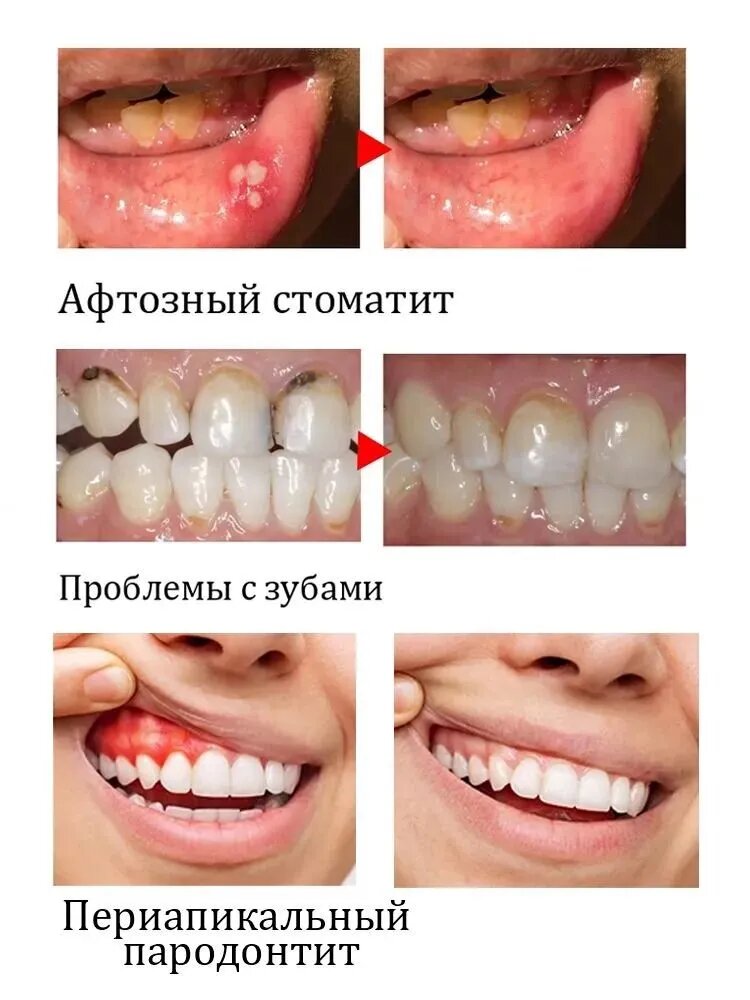 Быстрое снятие боли. 100% эффективно. Спрей от зубной боли, при воспалении дёсен, кариесе, пародонтите и язвах во рту, помогает снять боль и отёк дёсен.