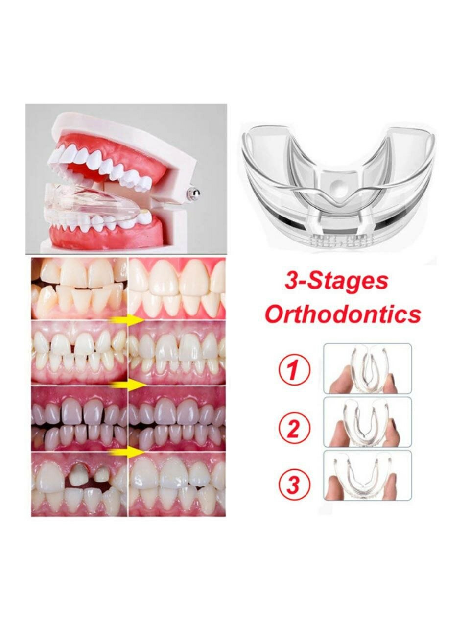 Ортодонтическая капа 1 Фаза, трёхступенчатая, взрослая, прозрачная