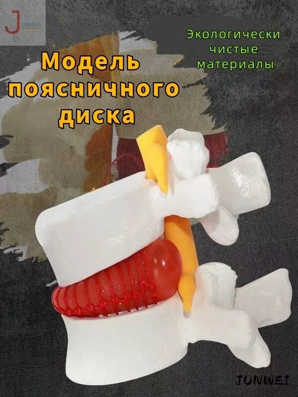Анатомическая модель позвоночника, грыжа межпозвоночного диска. Масштаб 1: 1,5