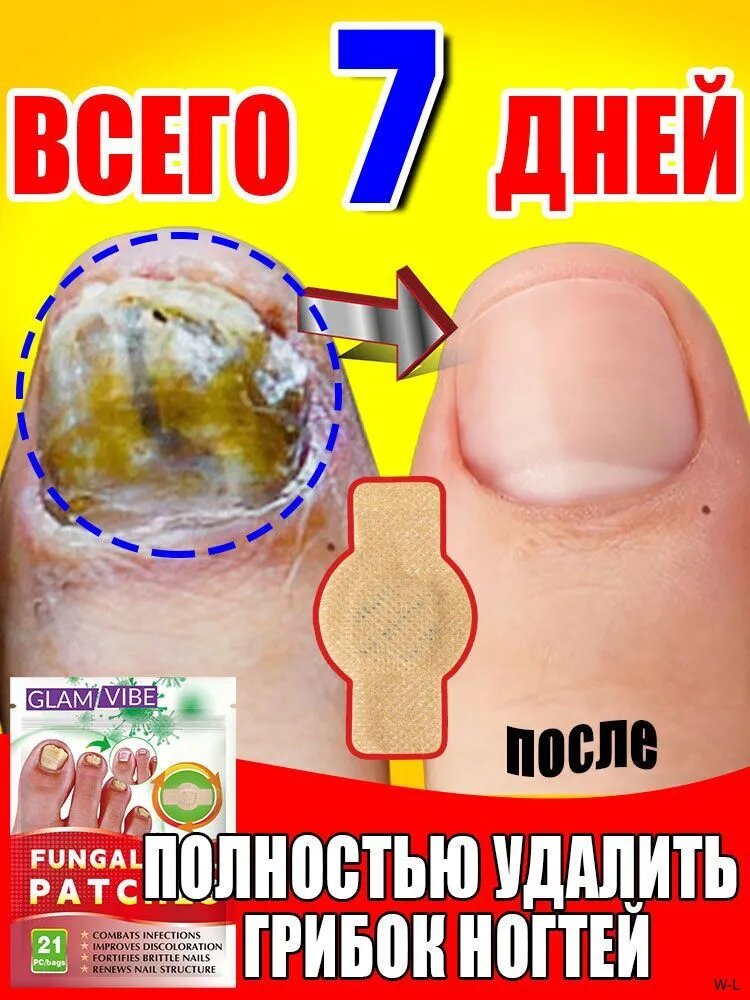 Пластырь для лечения ногтей для борьбы с грибком, Эффективное средство от грибка ногтей на ногах,21шт