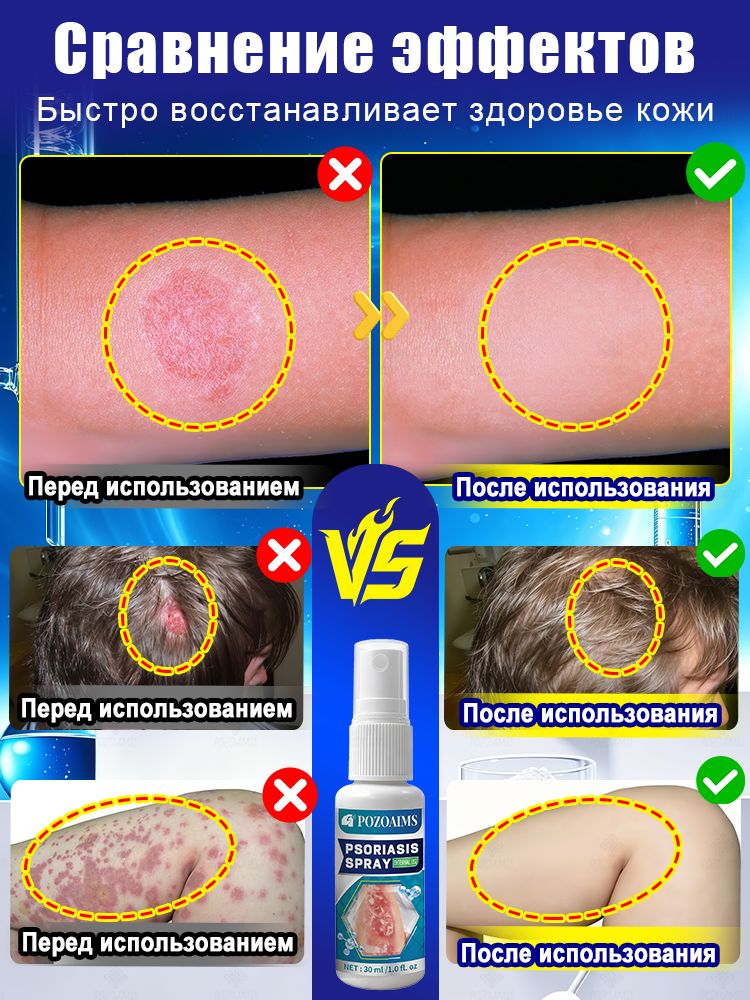 Спрей для кожи от сухости и зуда, средство для проблемной кожи, уход при псориазе и экземе, от раздражения и шелушения, 90 мл