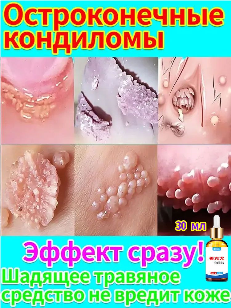 Крем для удаления остроконечных кондилом у женщин и мужчин. Лечение кондилом, папиллом и ВПЧ в интимной зоне и на коже. Средство от генитальных бородавок