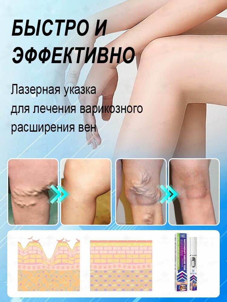Лазерная ручка для лечения варикозного расширения вен. Эффективно лечит сосудистые звездочки, тромбы, боли в ногах и отеки. Унисекс, 2 штука