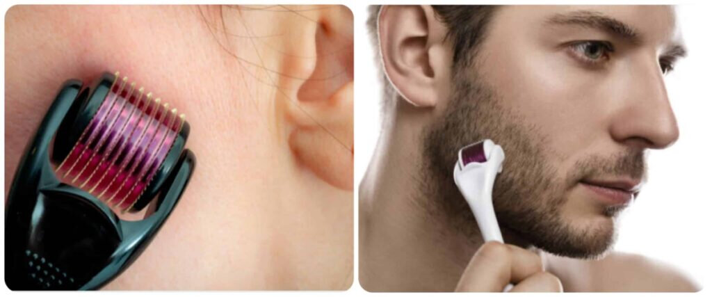 Дермороллер для усиления действия миноксидила, мезороллер — фото 1