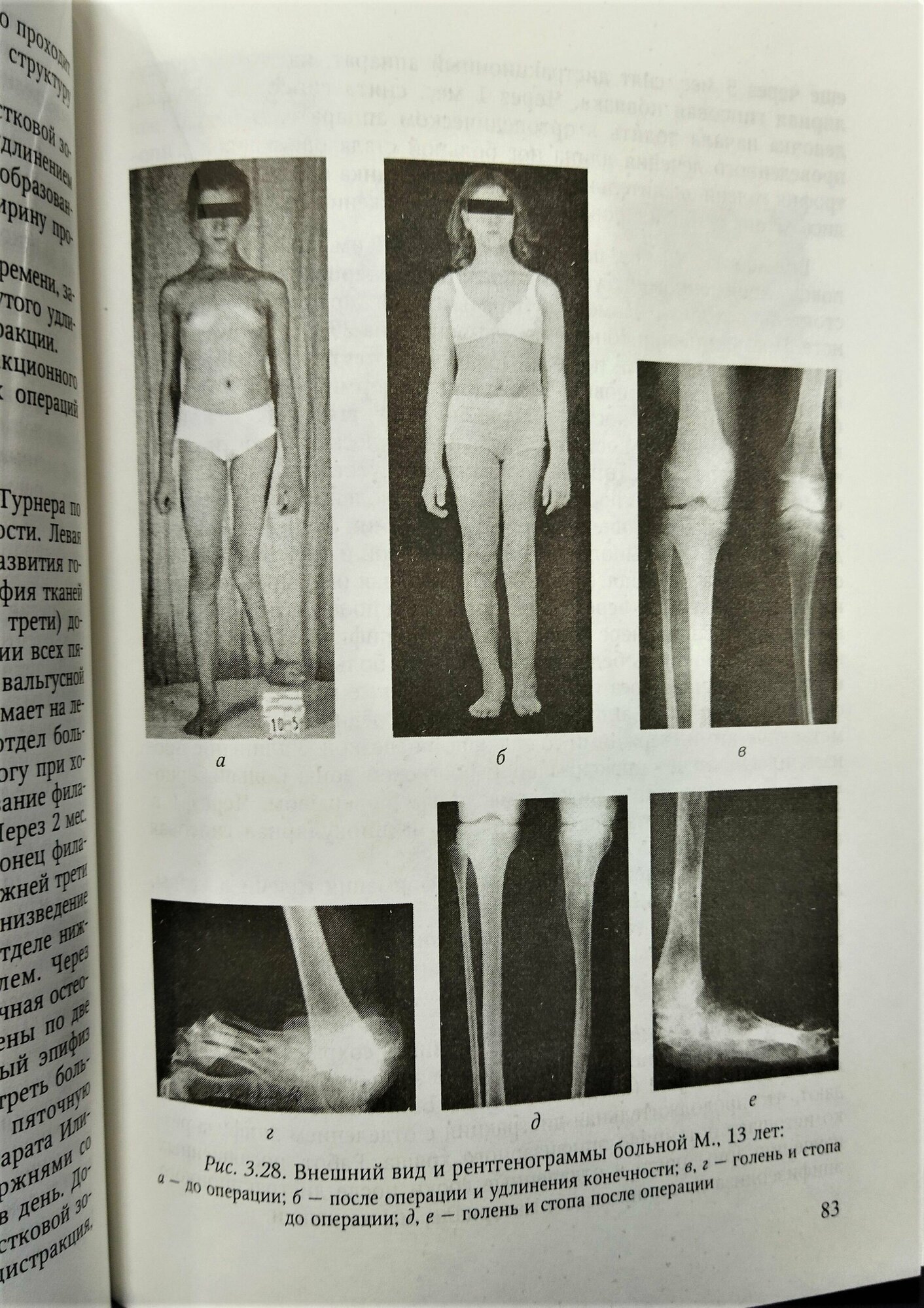Врожденные пороки развития костей голени у детей. Монография - фото №5