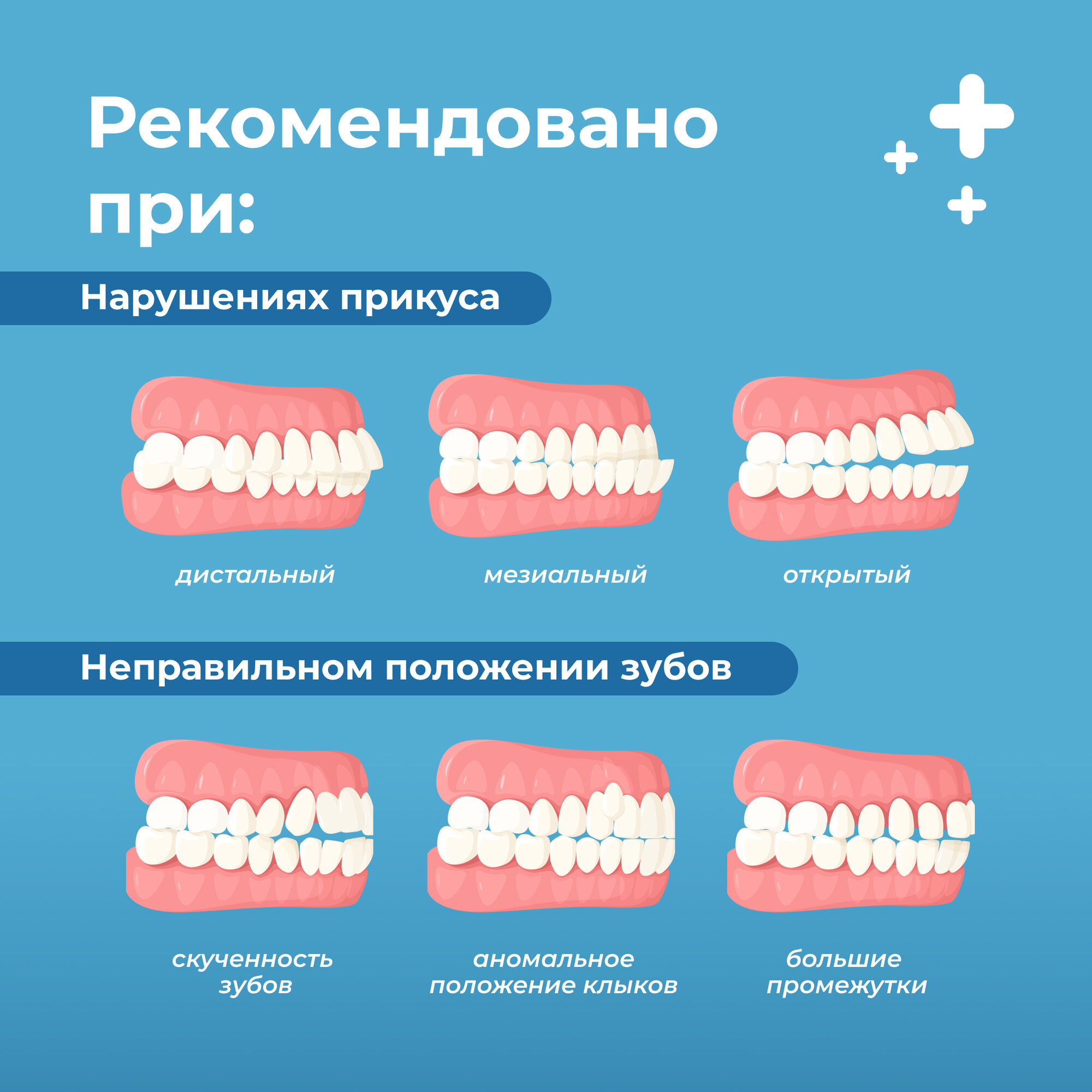 Набор кап для выравнивания зубов (трейнеры), 3шт, soft/medium/hard, LANDO — фото 1