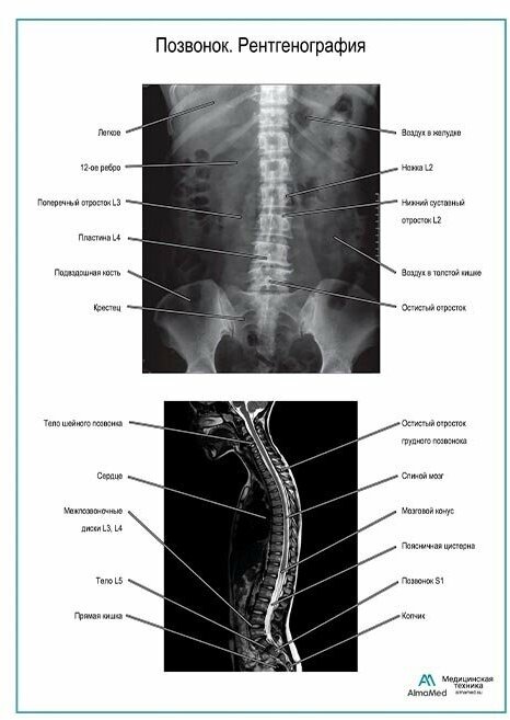 Позвонок. Рентгенография плакат, глянцевая фотобумага от 200 г/кв. м, размер A2+