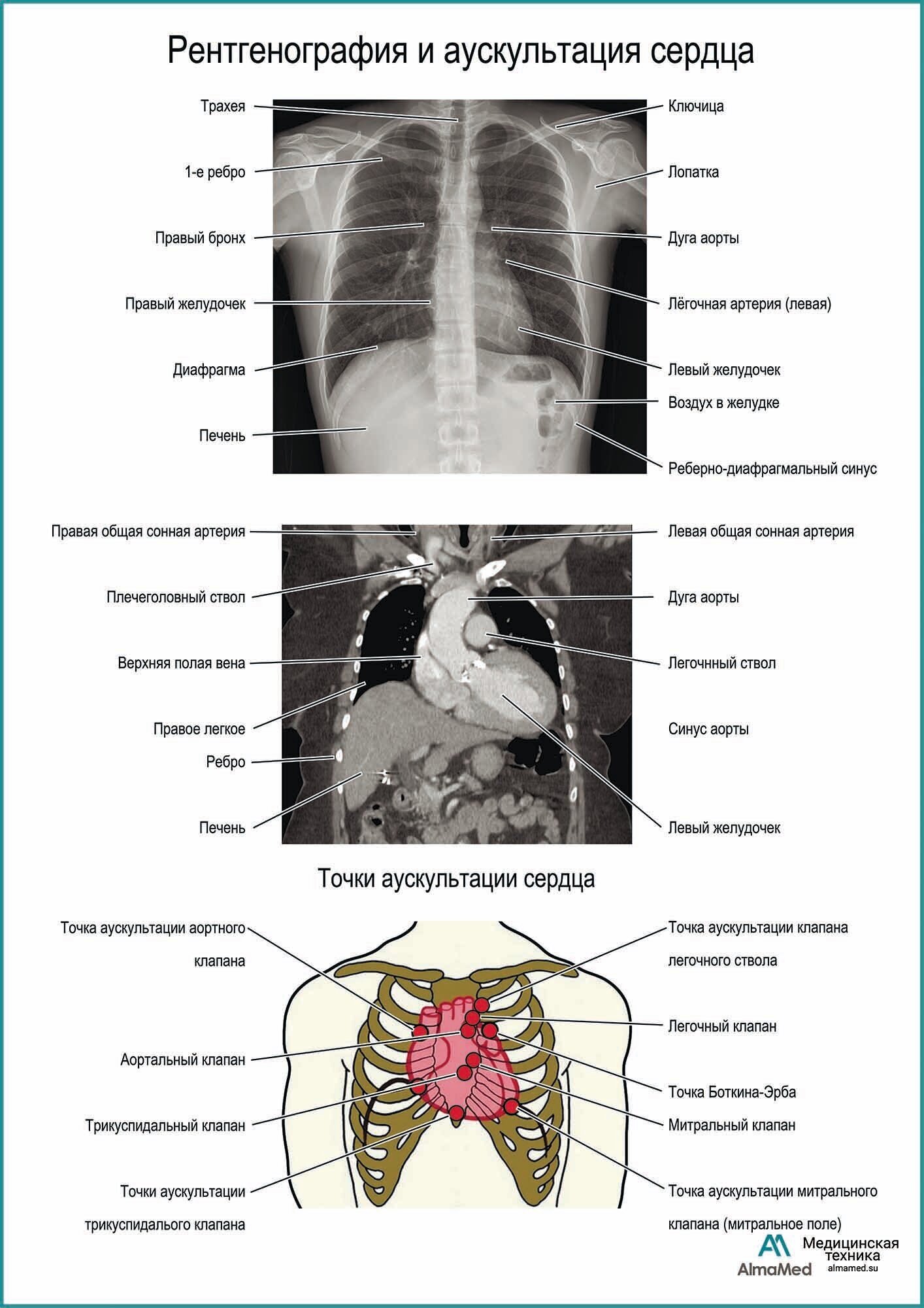 Рентгенография и аускультация сердца