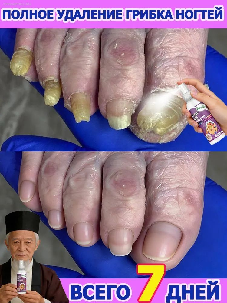 Спрей для ухода за кожей. Подходит для ухода за ногтями на ногах, борется с грибком ногтей, может быстро устранить онихомикоз. И восстановит здоровый цвет и гладкость ногтей в течение 2 недель.--NS928