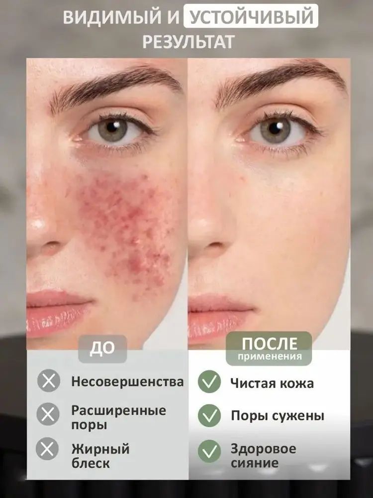 Крем для лица от прыщей и постакне, быстрое заживление, сужение пор и контроль масла, 30 г, для подростков и взрослых