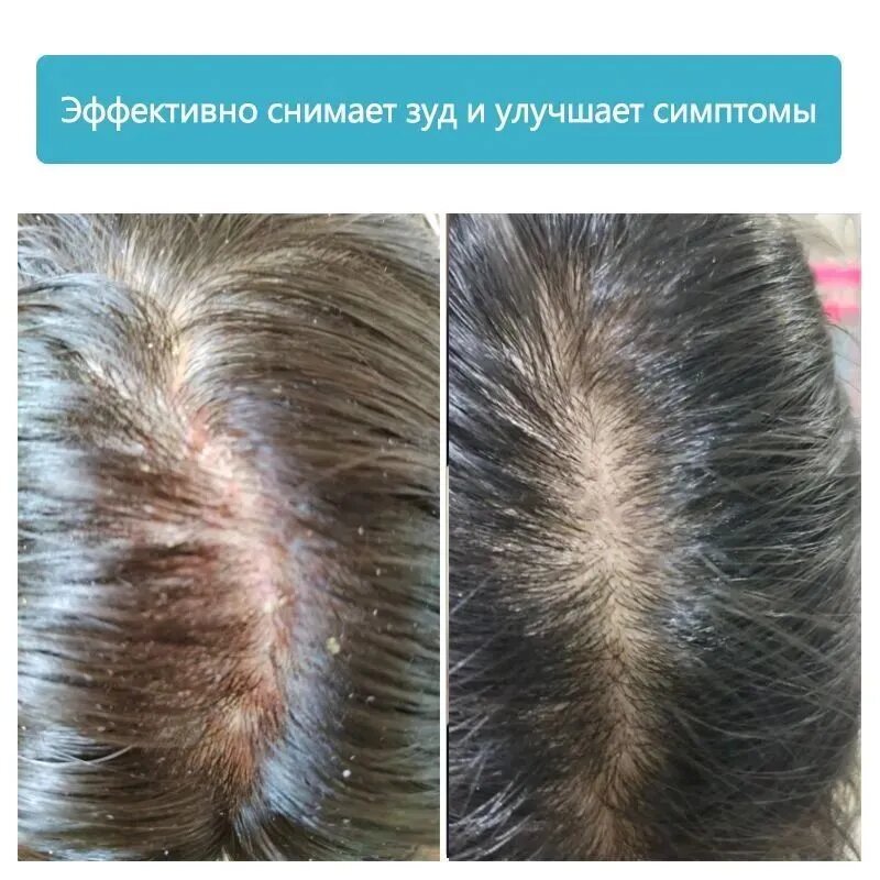 Средство для лечения кожи головы и волос
