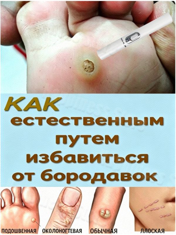 Ручка для удаления бородавок с синим светом, Нагревательная ручка синего цвета для удаления женских и мужских