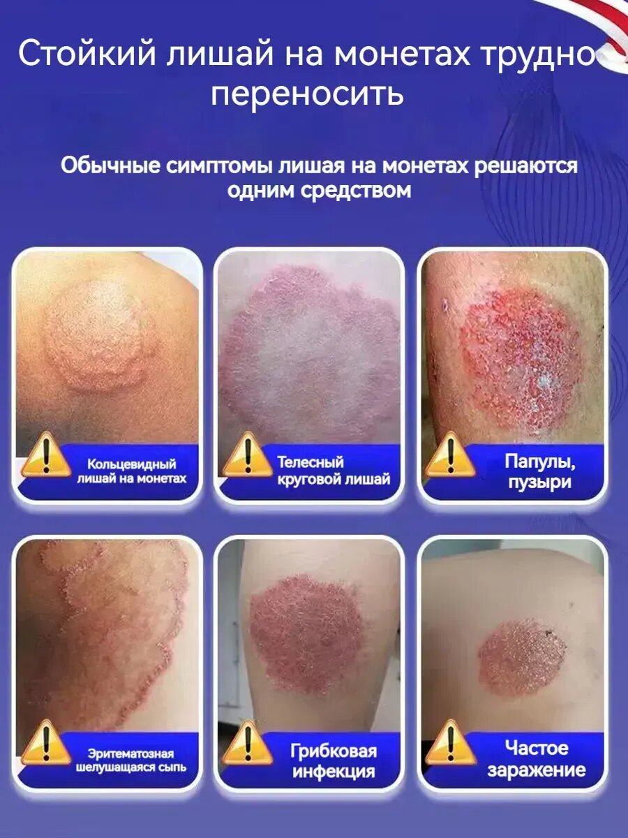 Мазь от лишая человеку на теле