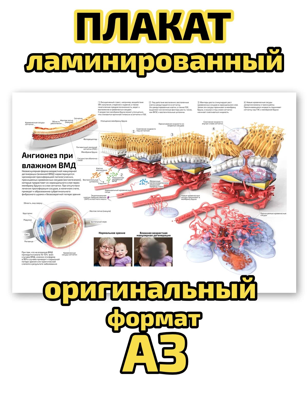 Плакат Квинг "Ангионез при влажном ВМД", ламинированный, А3, для изучения офтальмологии и медицины