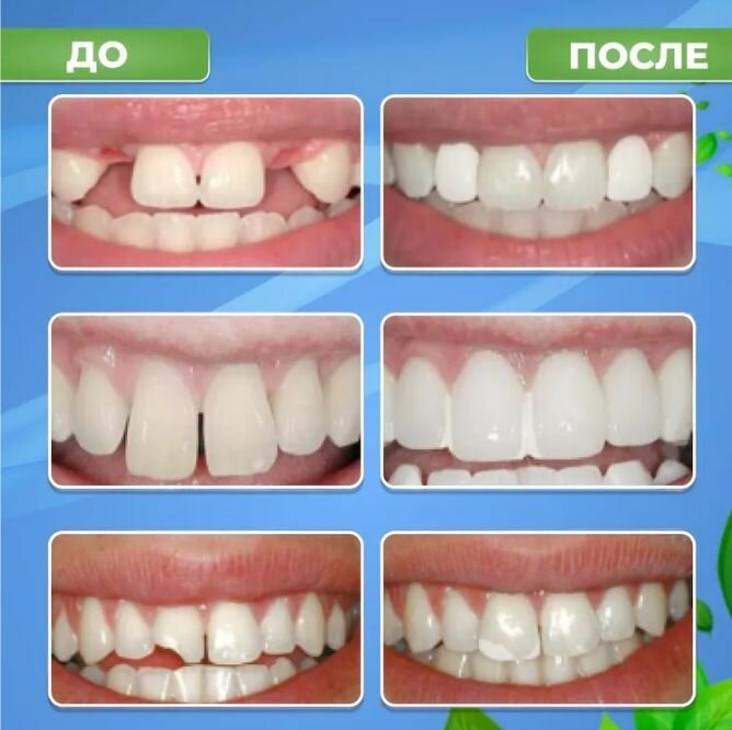 Временный зуб, Материал для создания зуба временный HOMTOPY 100г — фото 1